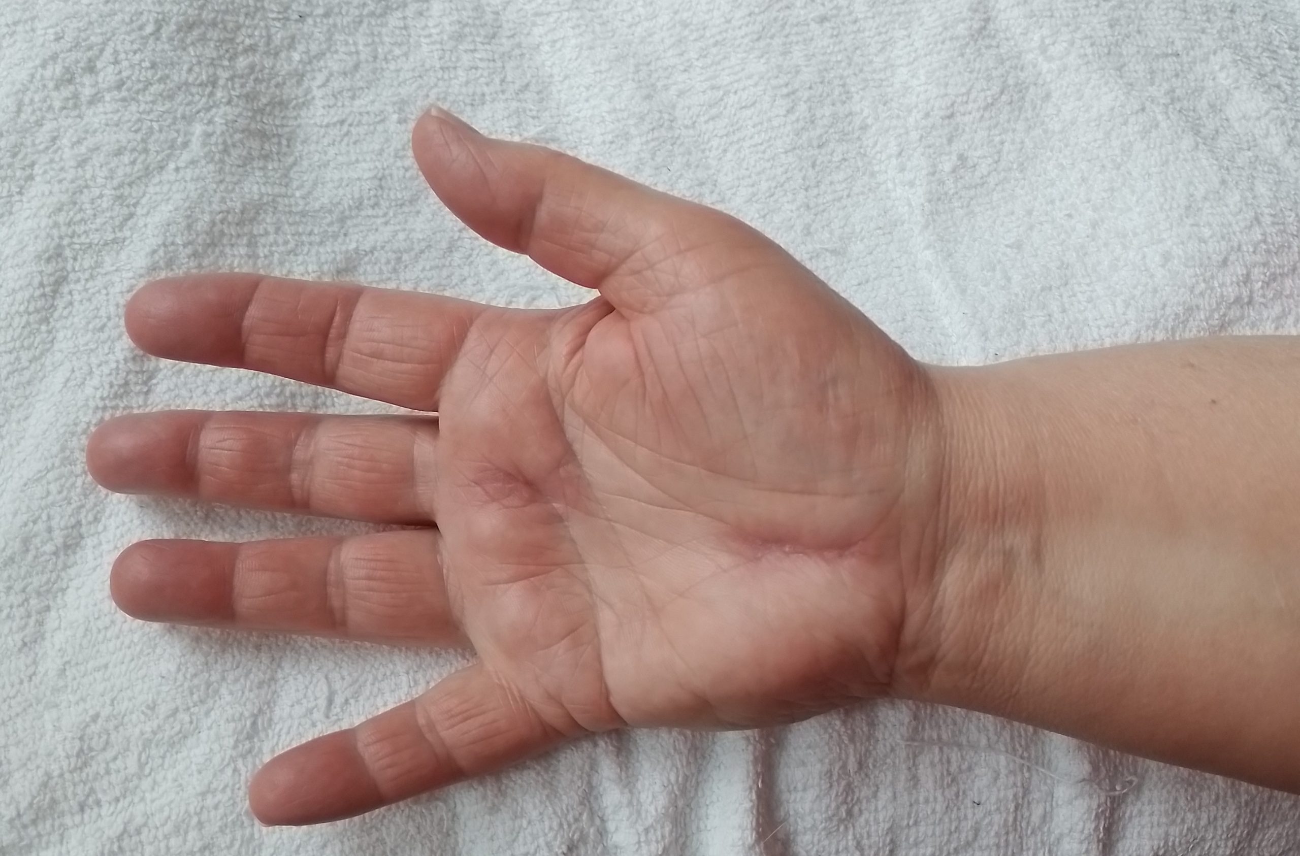 Operatie carpaletunnelsyndroom rechts 2022 na 7 weken